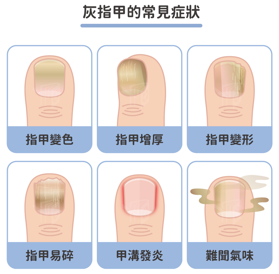 指甲變黑、變厚就是灰甲嗎？拆解灰甲常見症狀，及早發現是關鍵
