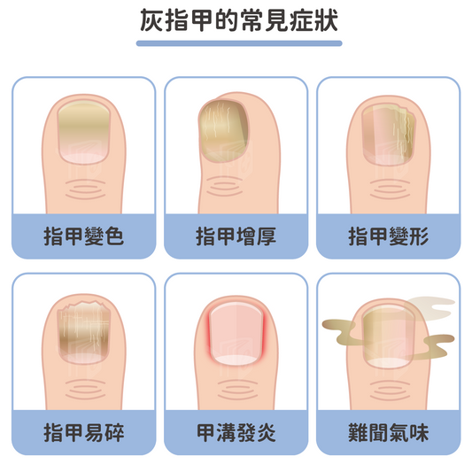指甲變黑、變厚就是灰甲嗎？拆解灰甲常見症狀，及早發現是關鍵